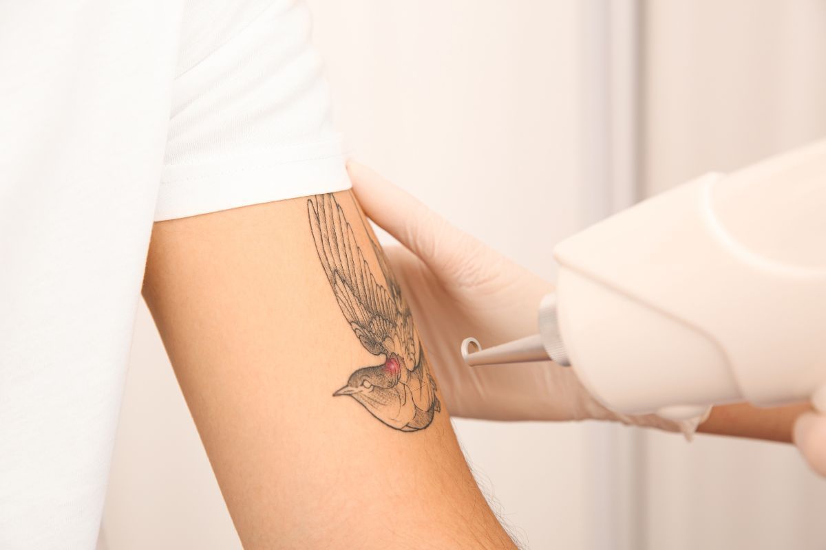 rimuovere tatuaggio