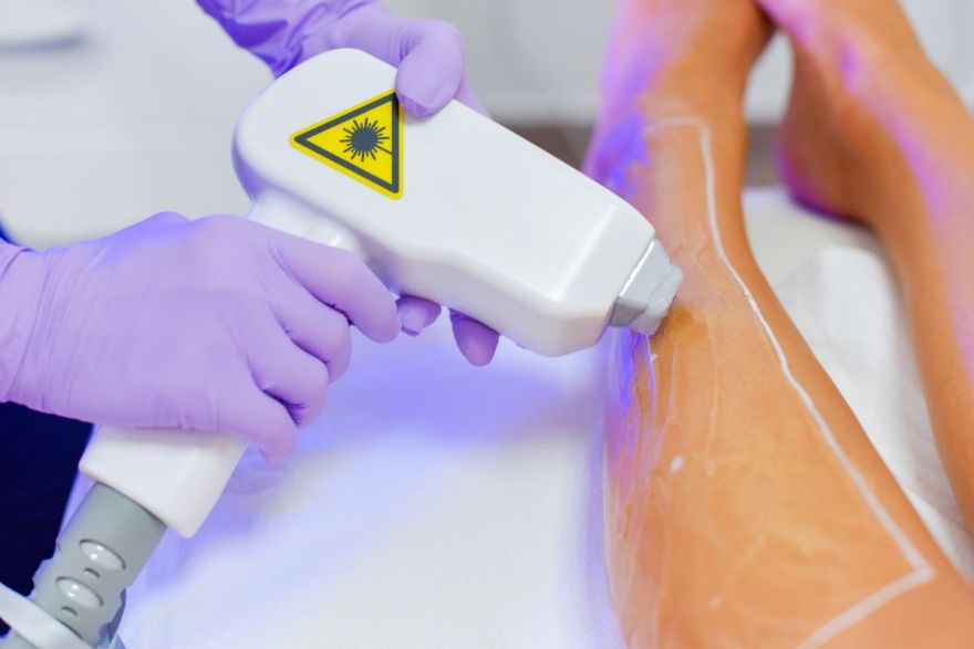 epilazione laser diodo
